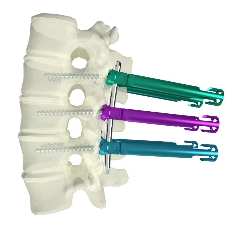 胸腰椎后路內(nèi)固定系統(tǒng)